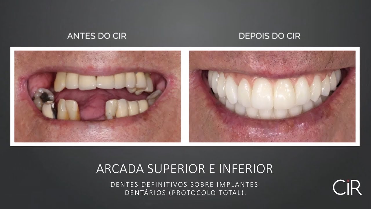 Antes e Depois - Implantes Dentários (Protocolo Total)