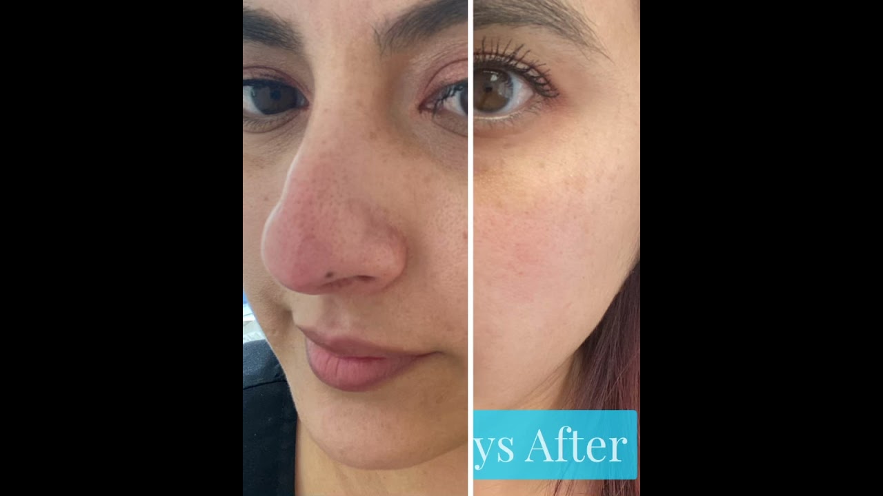 Vi-Peel Purify with Precision Plus Before and After