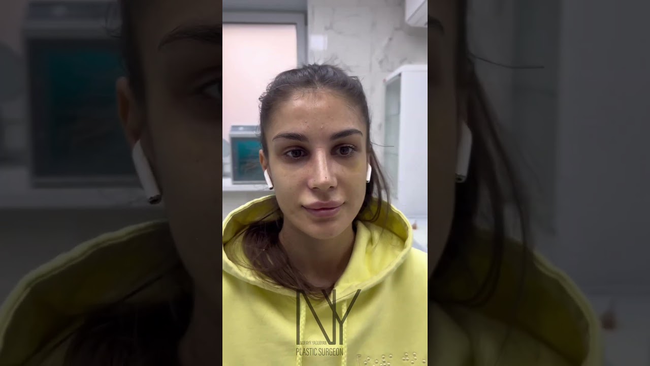10 день после ринопластики у великолепного пластического хирурга- Норайра Валерьевича