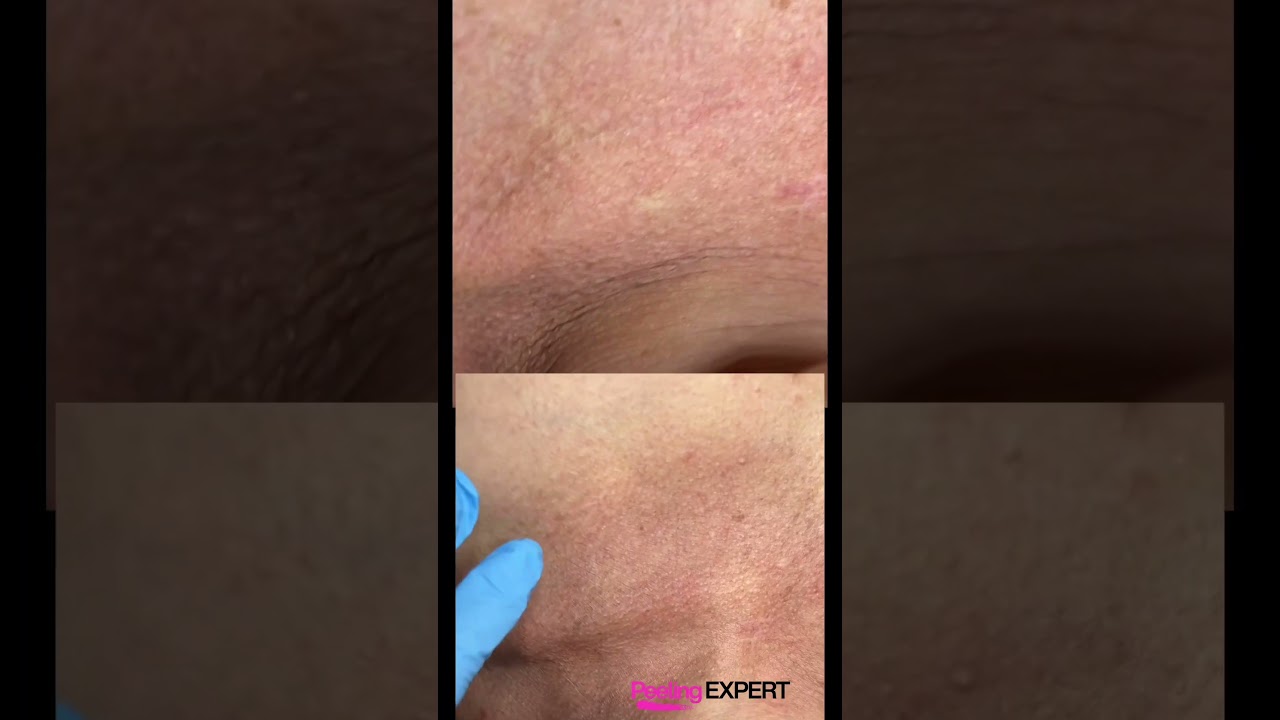 Peeling no Pescoço | Antes e depois 
