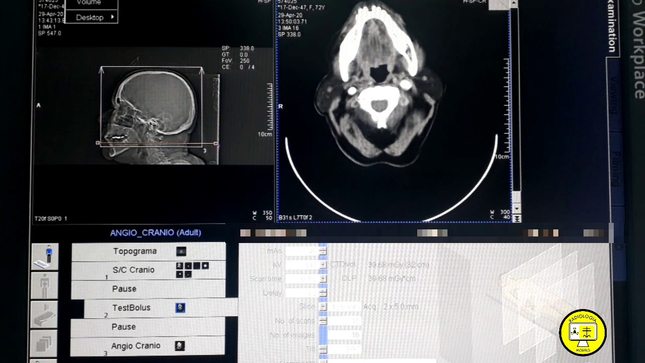 ANGIOTOMOGRAFIA DE CRÂNIO - PROF DIEGO CESAR