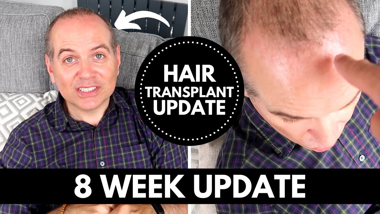 IS THE HAIR TRANSPLANT WORKING ? | 8 WEEK UPDATE