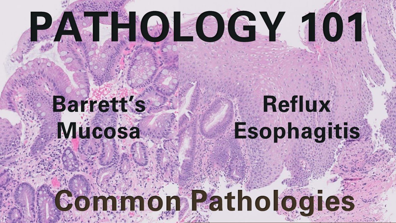 Reflux Esophagitis & Barrett's Esophagus | Pathology 101
