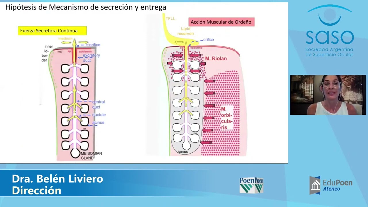 Ateneo SASO: Disfunción de las glándulas de Meibomio (DGM)