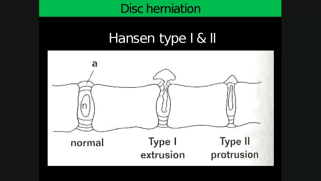 Spinal lecture 2 Degenerative