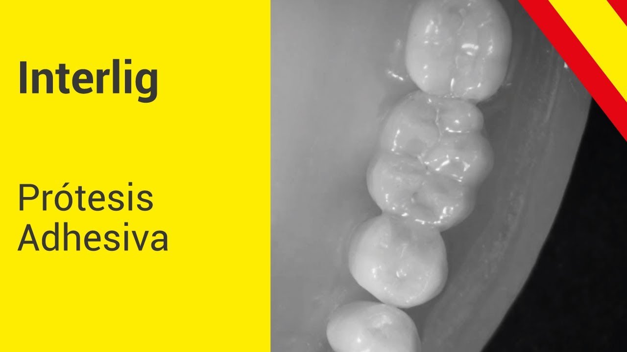 INTERLIG - Pr&oacute;tesis Adhesiva