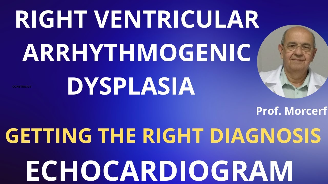 RIGHT VENTRICULAR ARRHYTHMOGENIC DYSPLASIA