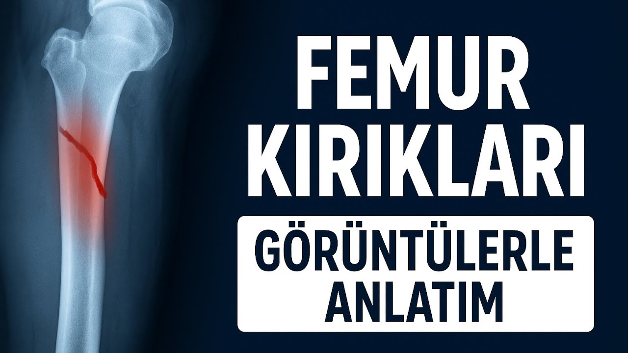 🚨Femur(Uyluk Kemiği) Kırıkları ve Tedavisi‼️✔️