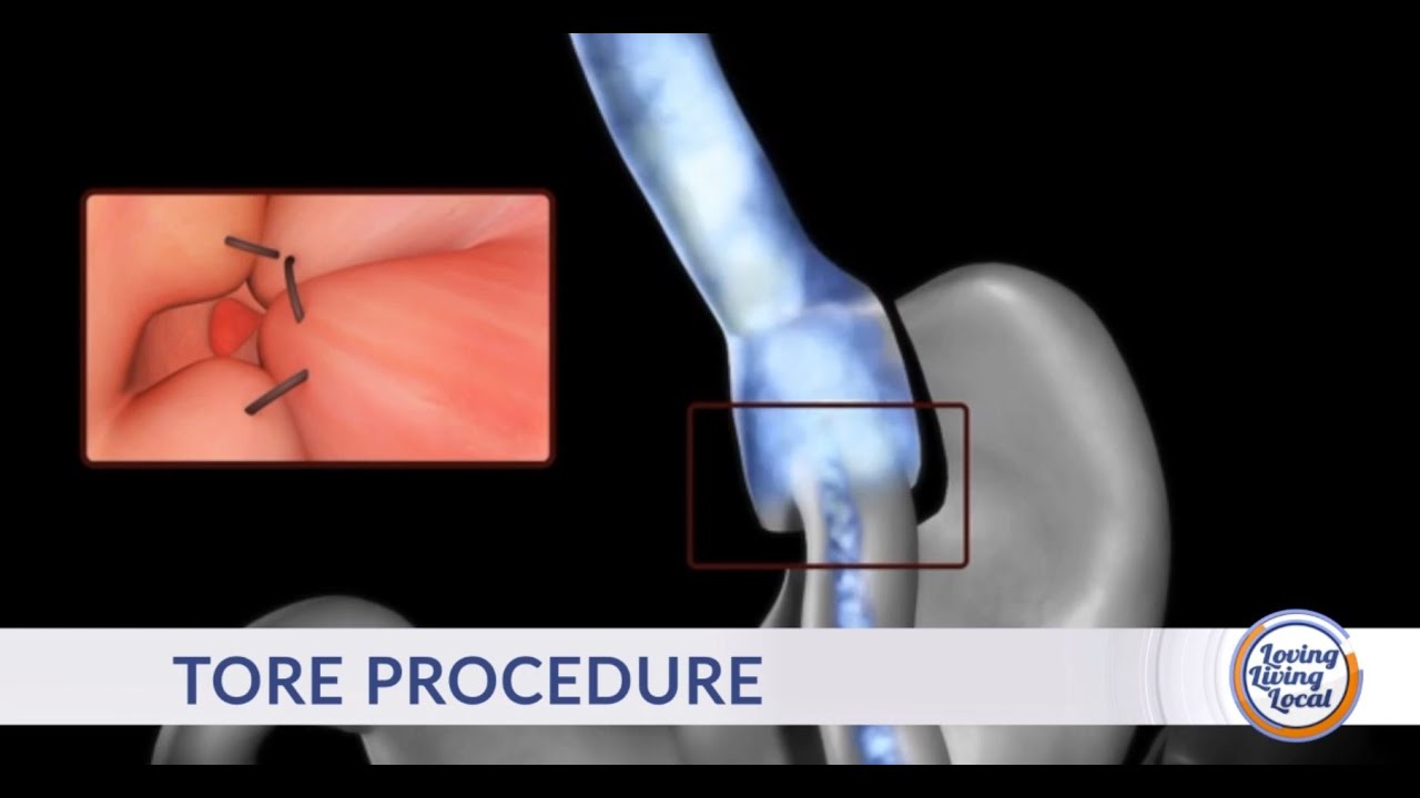 Medical Monday: The Tore Procedure