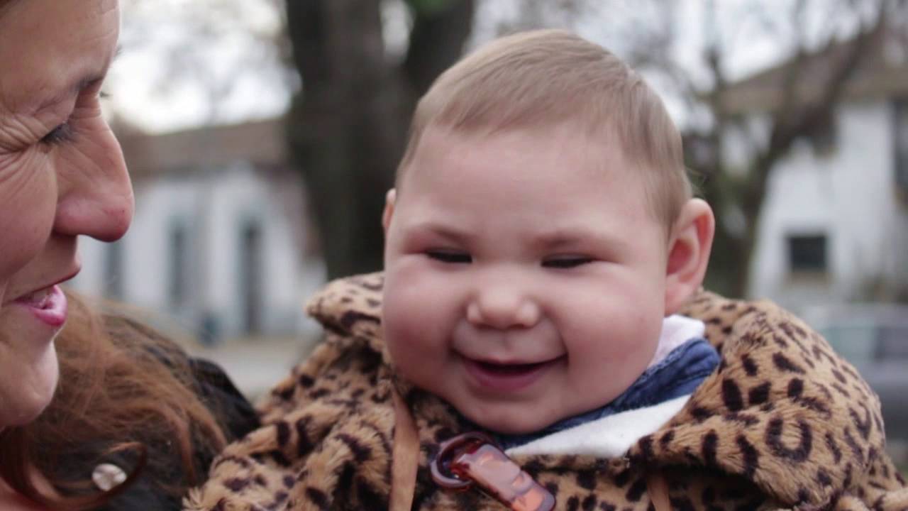 NIÑA MICROCEFALIA