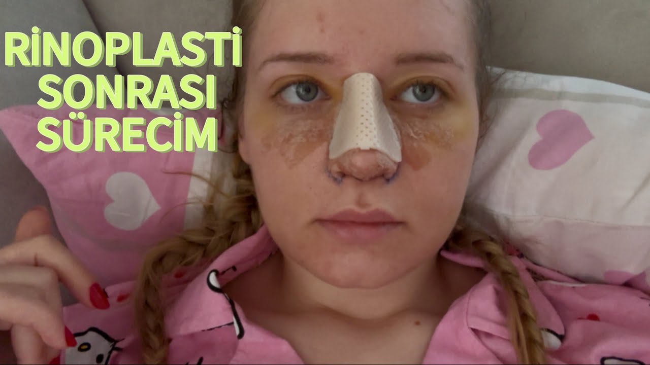 RİNOPLASTİ(Burun Estetiği) SONRASI 2 HAFTALIK SÜRECİM ✨ vlog 