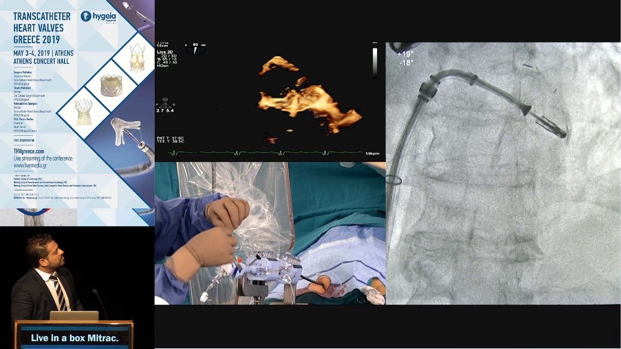 K. Papadopoulos | Live-in-a-box Mitraclip | Mitral Session I &ndash; Complexities of Mitral Interventions