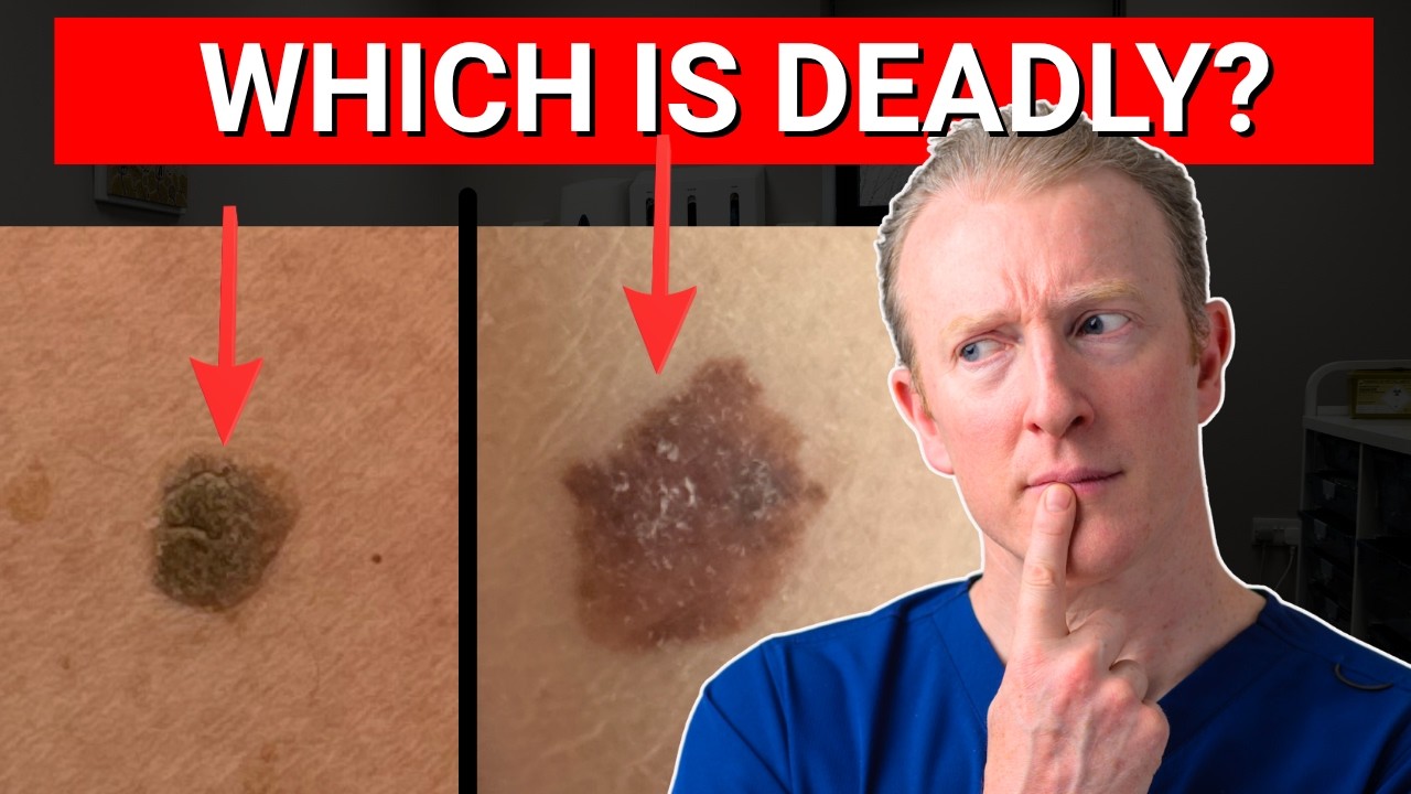 Mole vs Melanoma: 3 Things You MUST Know