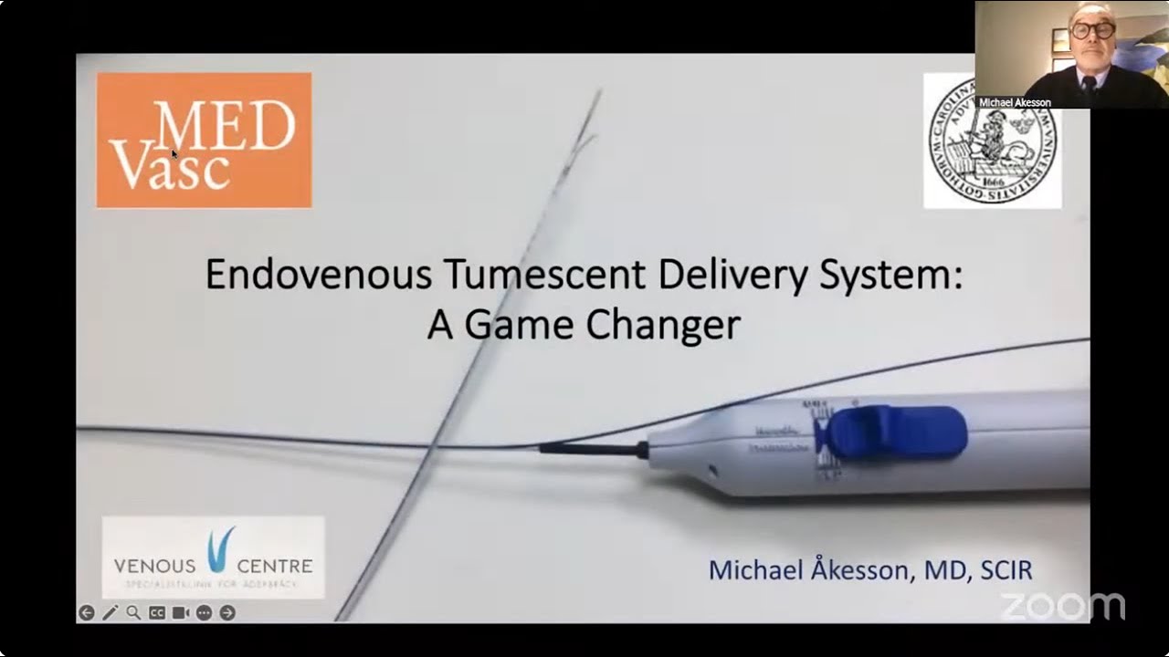 VEIN UNIVERSITY GRAND ROUNDS: Endovenous Tumescent Delivery System: A Game Changer