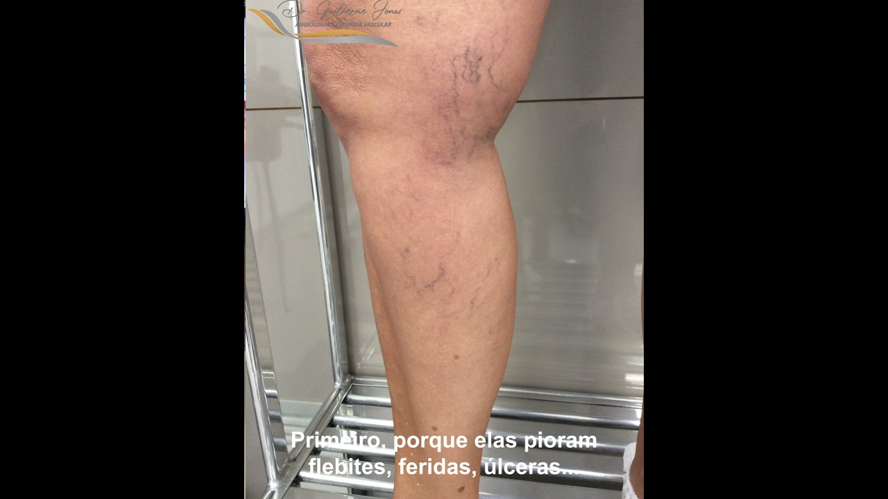 Por que tratar as varizes?