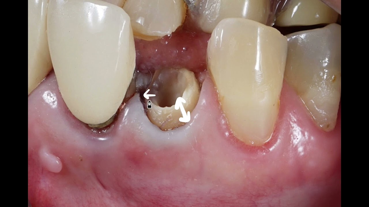 Ferrule Effect :Dr. Ziad F. Abusidu