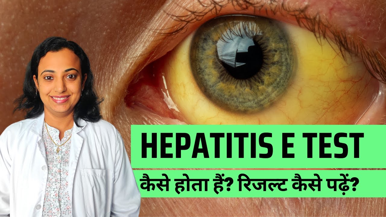Hepatitis E Test Procedure, Symptoms, Infection, Reasons and More
