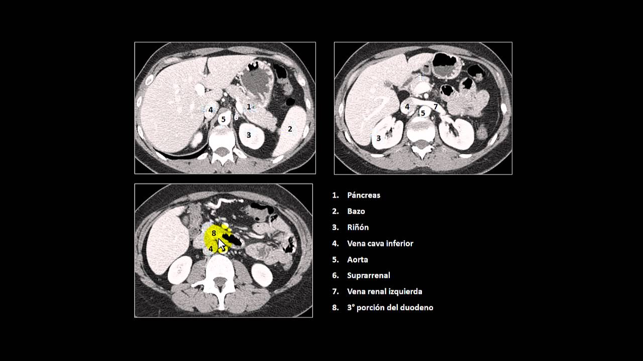 tc abdomen retroperitoneo