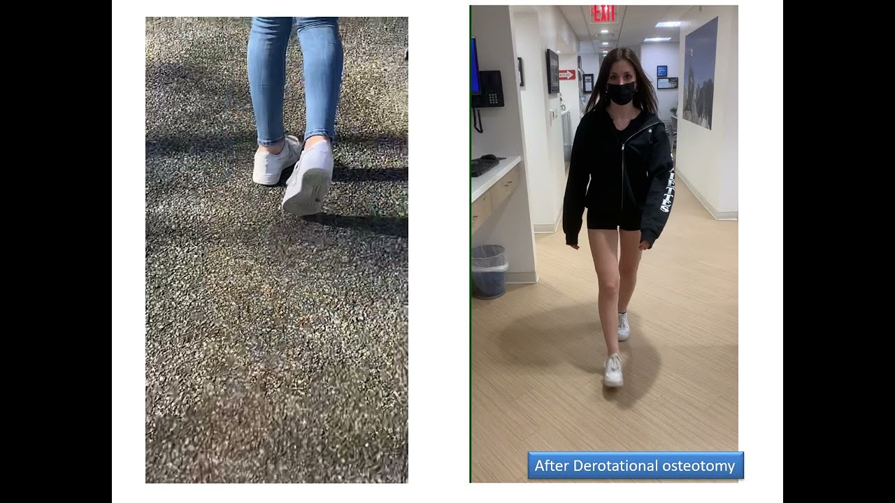 Dr. Rozbruch discusses treatment of excessive femoral anteversion or in-toeing gait