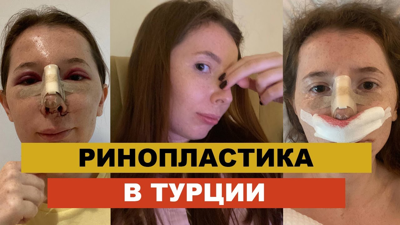 РИНОПЛАСТИКА В ТУРЦИИ | МОЯ ИСТОРИЯ | CКОЛЬКО СТОИТ | НЕ ДЫШИТ НОС