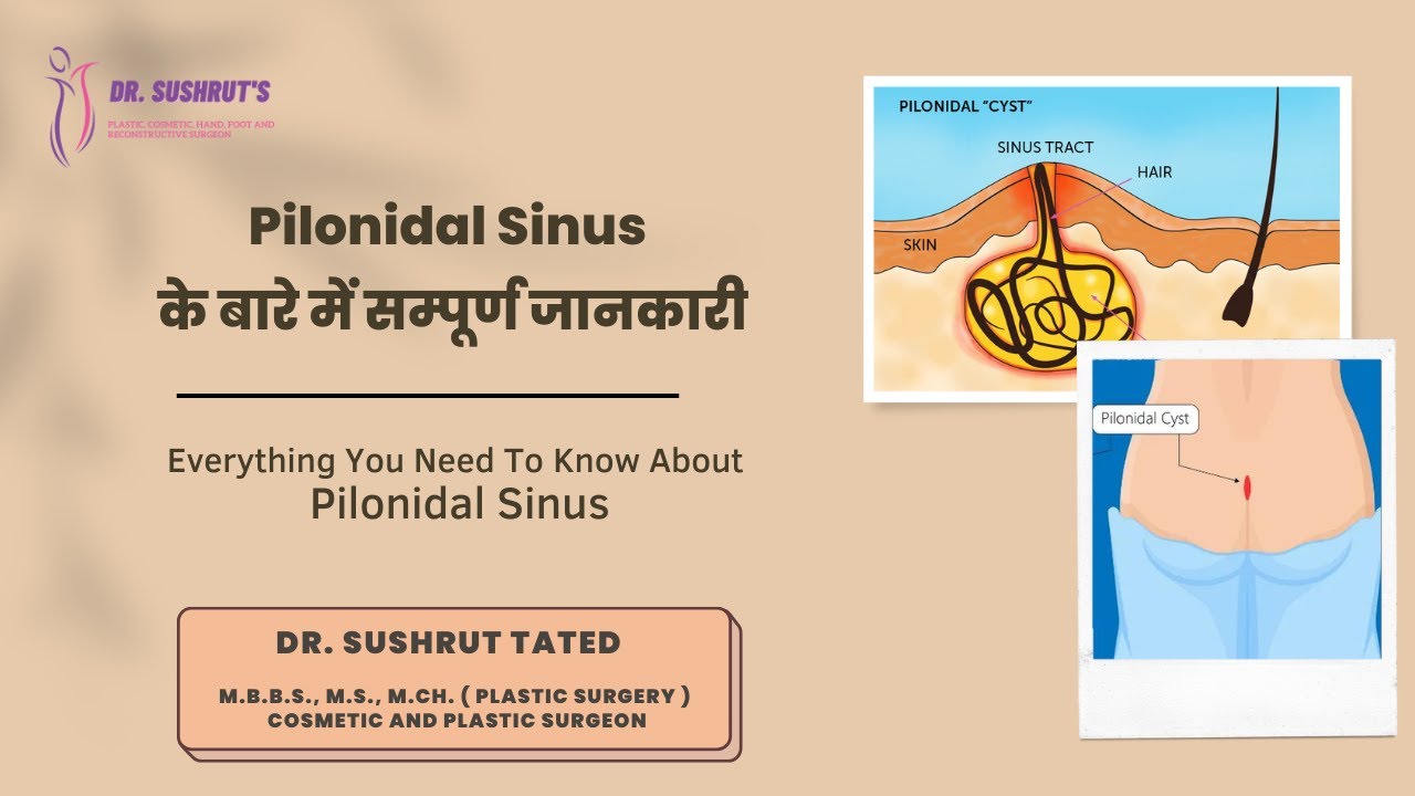 Pilonidal Sinus के बारे में सम्पूर्ण जानकारी | Complete Overview About Pilonidal Sinus - Dr. Sushrut