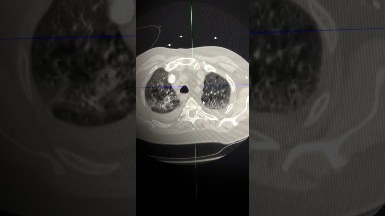CT assessment - understanding heart failure / pulmonary oedema on CT #radiology