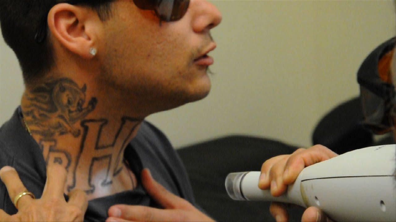 Gang-related tattoo removal at Homeboy Industries