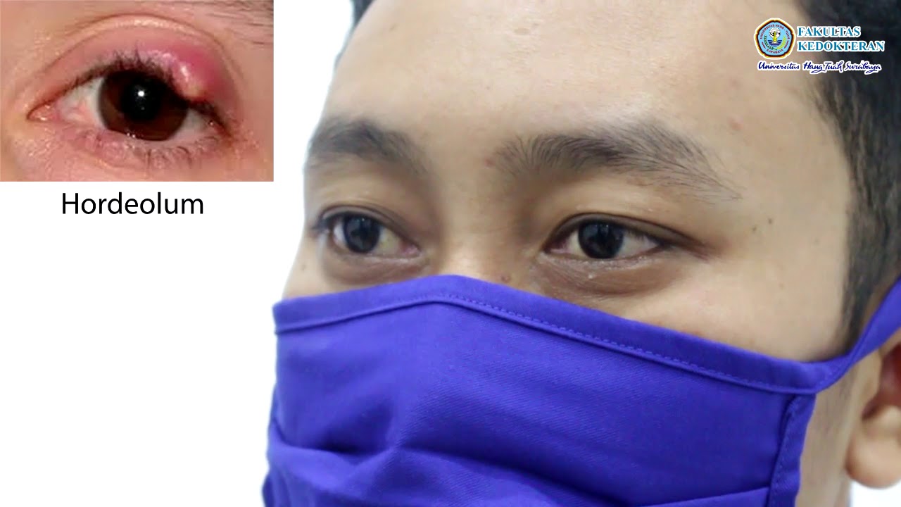 Panduan Keterampilan Medik Pemeriksaan Segmen Anterior Mata (Camera Occuli Anterior Examination)
