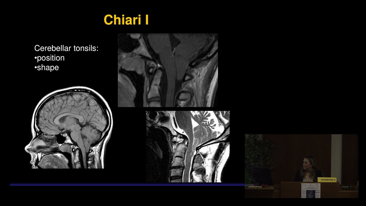 Paola Sciortino. Radiological  criteria  in Chiari 1 Malformation  and Syringomyelia