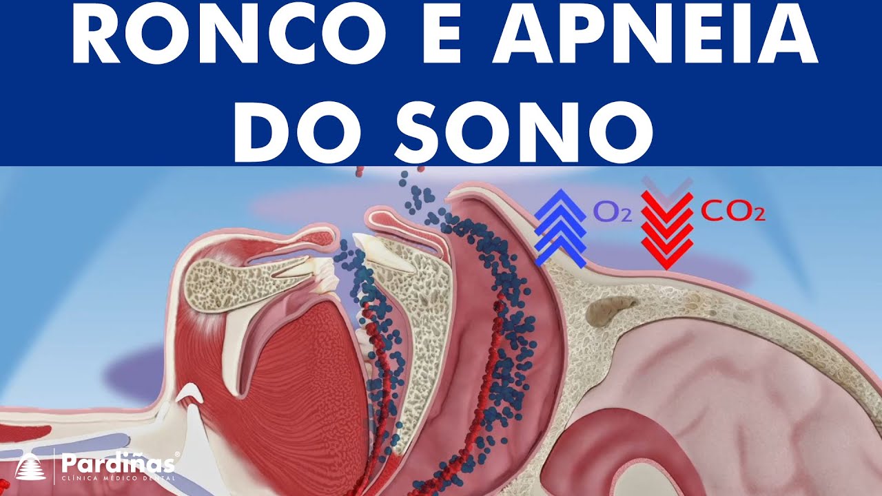 Ronco apneia do sono &copy;