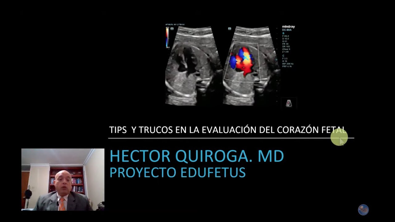 Ecocardiografía fetal: Tips y trucos en la evaluación del corazón fetal