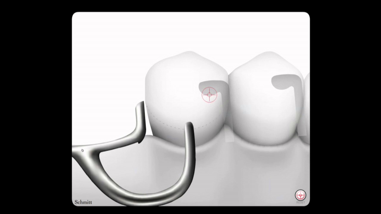 How An RPI Retainer Rotates