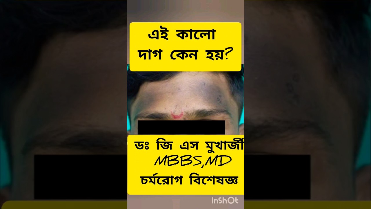 এই কালো দাগ কেন হয় ? #dermatologist #hyperpigmentation #skinspecialist #drgsmukherjee