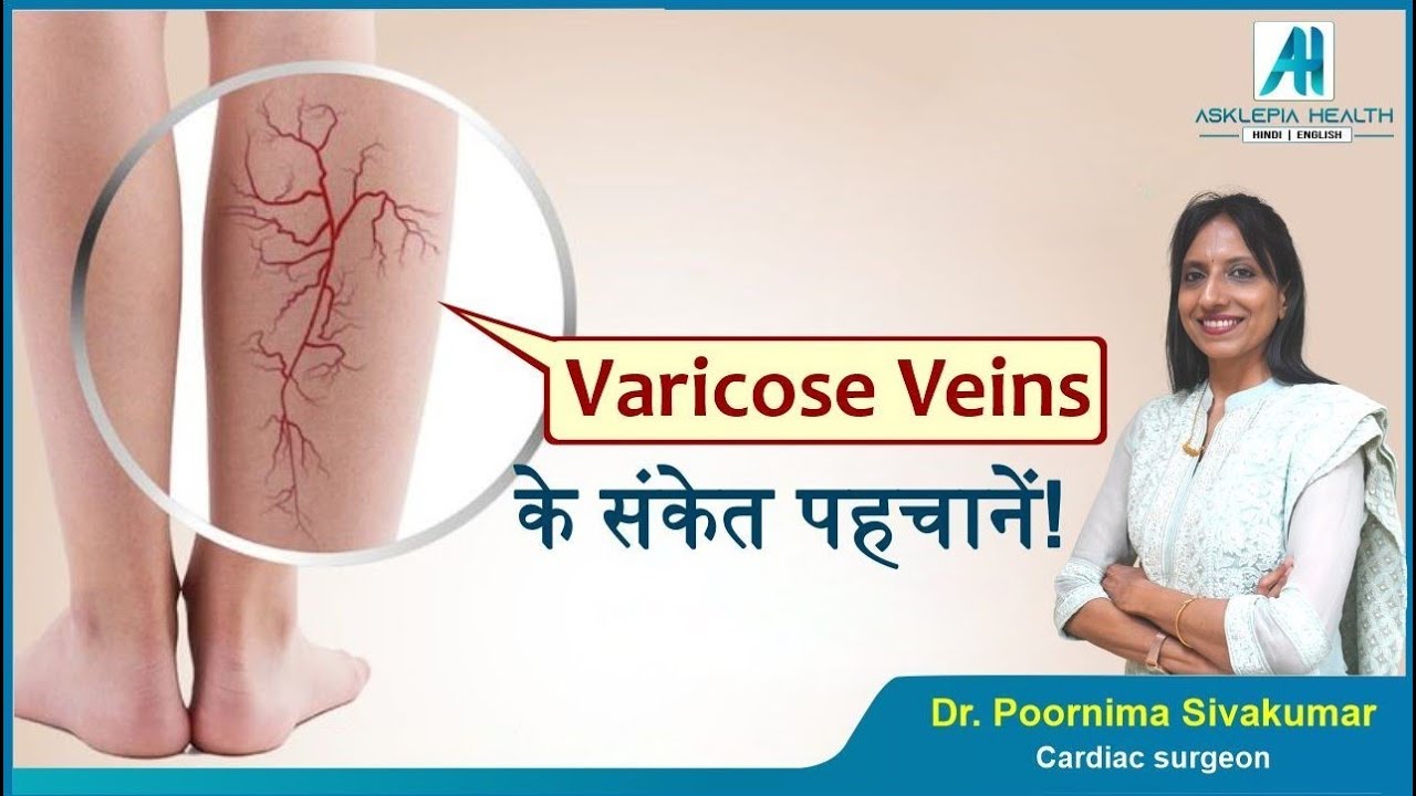 Varicose Veins: Causes, Symptoms & Treatment - Dr. Poornima Sivakumar