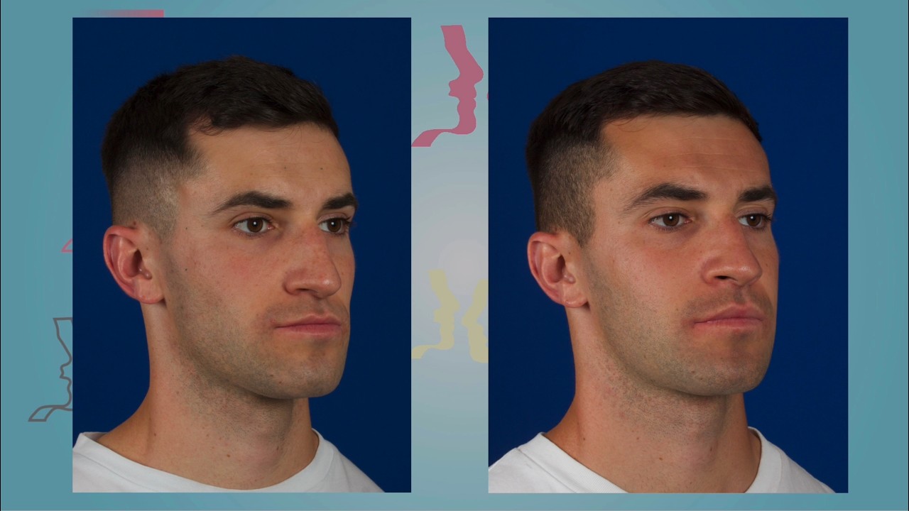 Case 17 - Orthognathic surgery - Class III - English