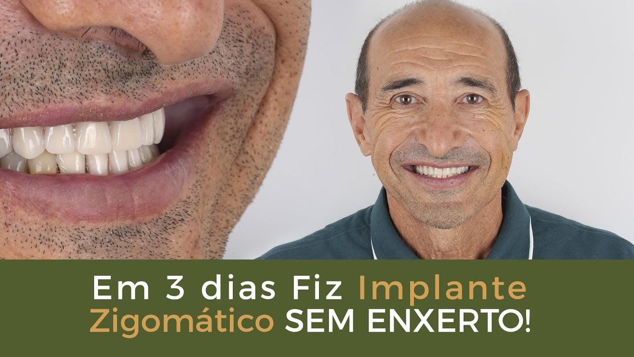 Fiz Implante Zigomático em 3 Dias e Sem Enxerto! - Implace Implantes