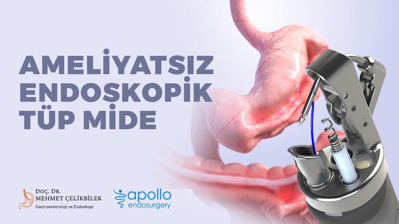Ameliyatsız Endoskopik Tüp Mide İşlemi I Doç. Dr. Mehmet ÇELİKBİLEK