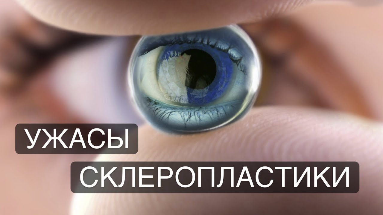 Склеропластика не решает проблему близорукости