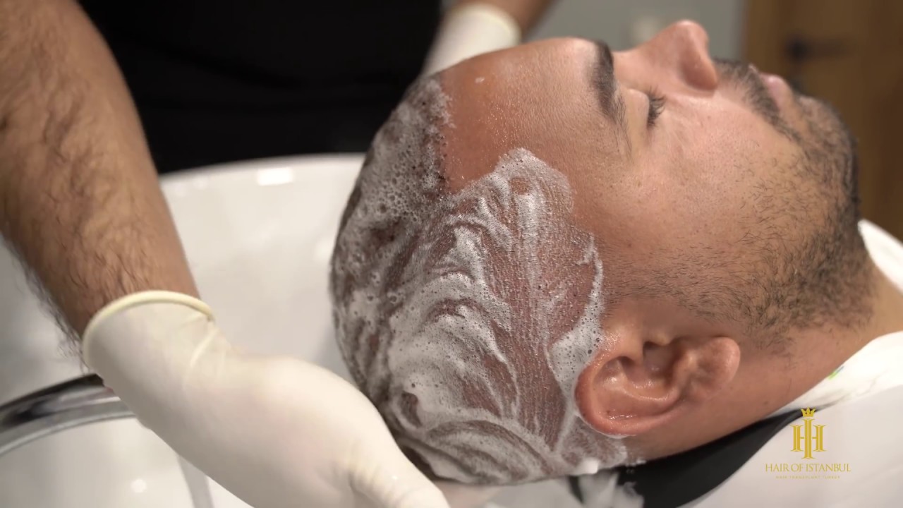 How to wash your hair after hair transplant?