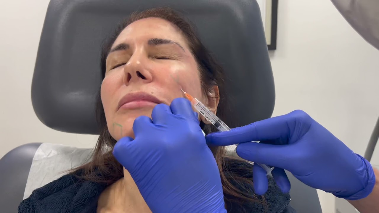 Panfacial rejuvenation using Sculptra and Dysport by Dr. Shaun Patel in Miami, Florida.