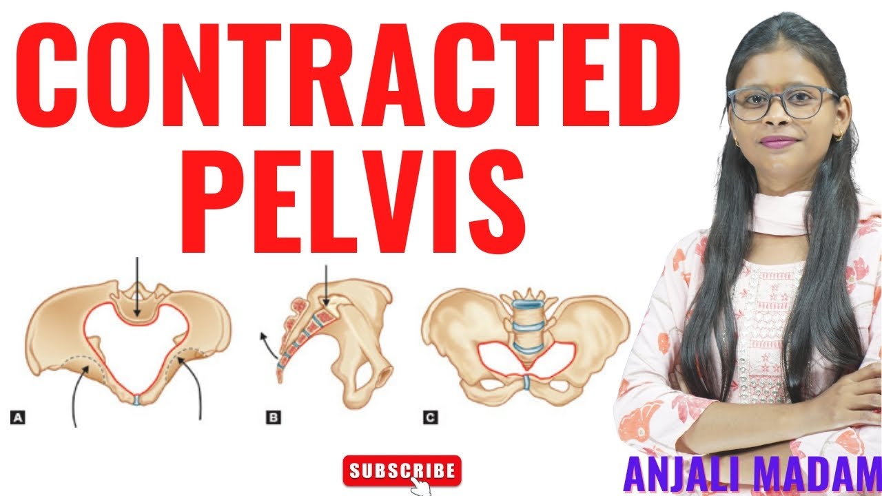 Contracted Pelvis II Midwifery and Gynaecological Nursing II Anjali Mam II