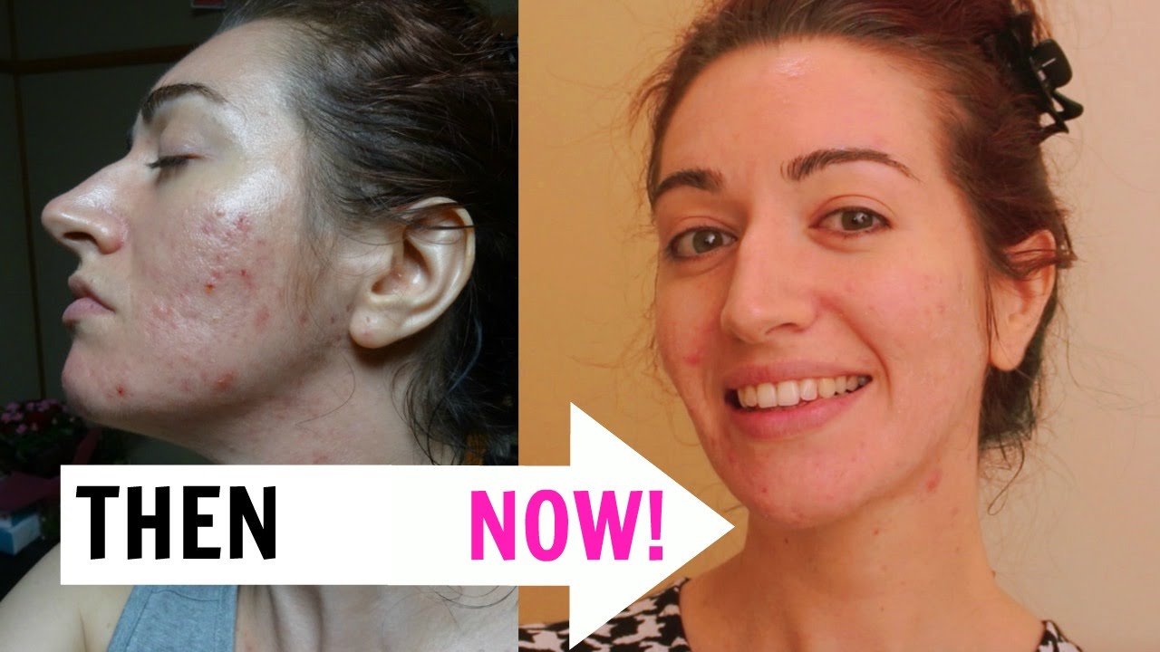 MY SKINCARE ROUTINE FOR ACNE PRONE/OILY SKIN
