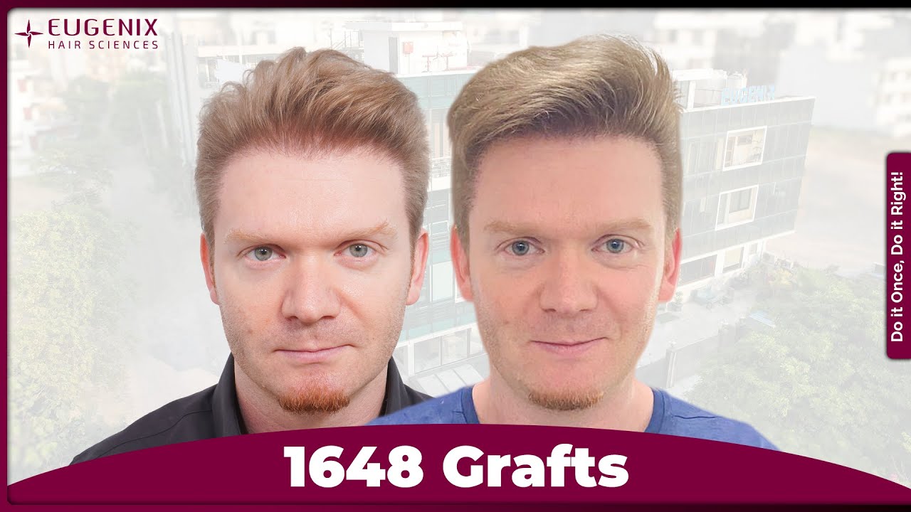 7th Hair Transplant Journey: Henry’s Corrective Repair Case from Australia to Eugenix Hair Sciences