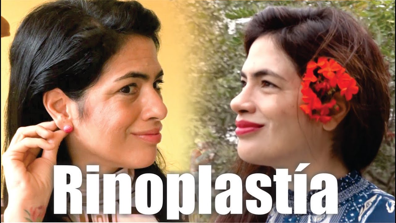 RINOPLASTÍA y OTOPLASTÍA a la vez 😍 CIRUGÍA PLÁSTICA de DETALLES 💝 Dr ALBERTO CALVO QUIROZ (ACQ)