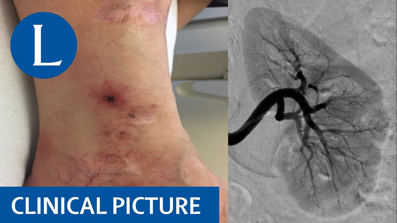 Deficiency of adenosine deaminase 2: a confusing mimic