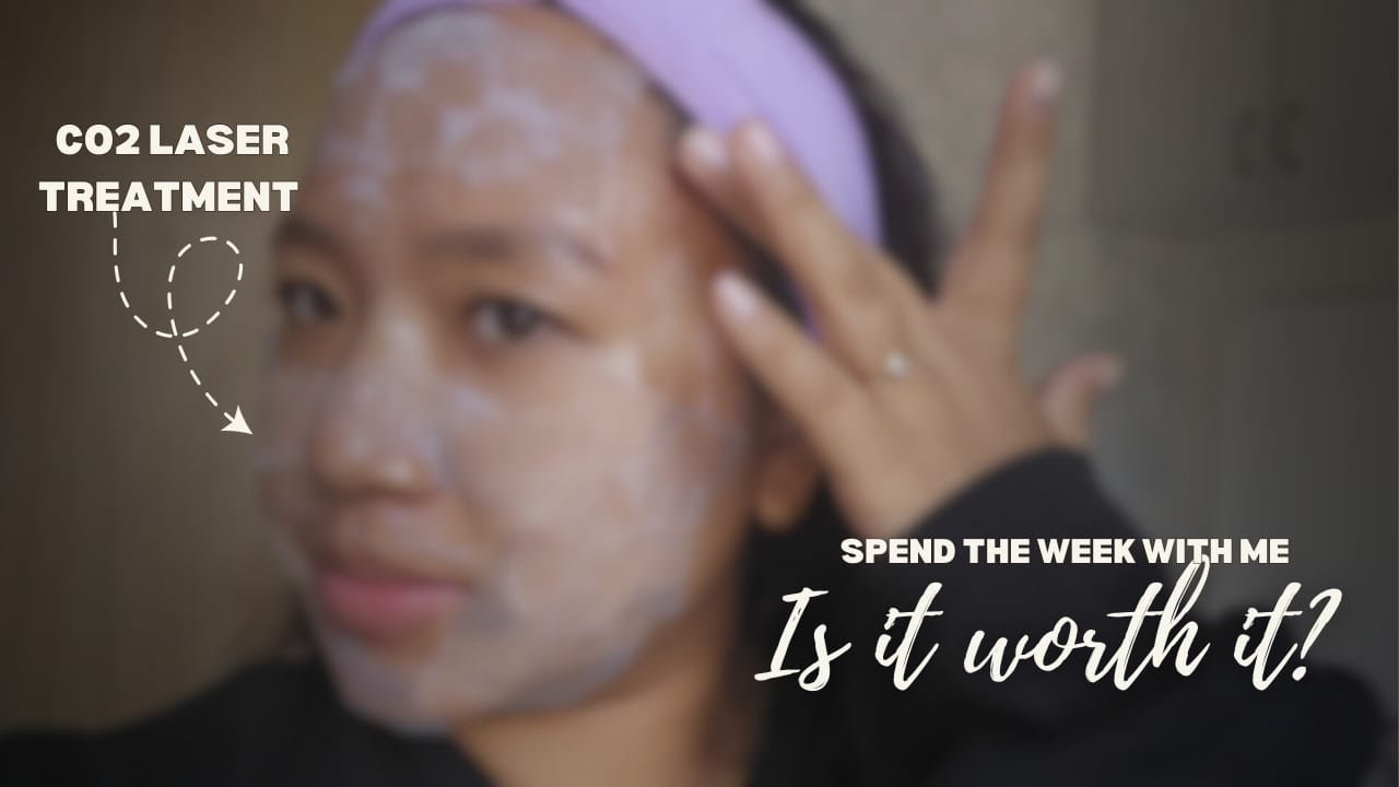 CO2 LASER TREATMENT FOR ACNE SCARS‼️IS IT WORTH IT❓