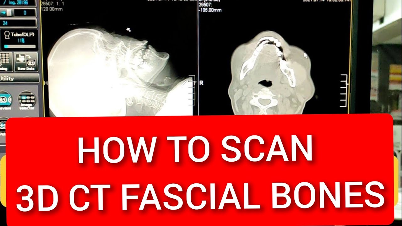 Fascial Bones CT scan Protocol | Live Demo.