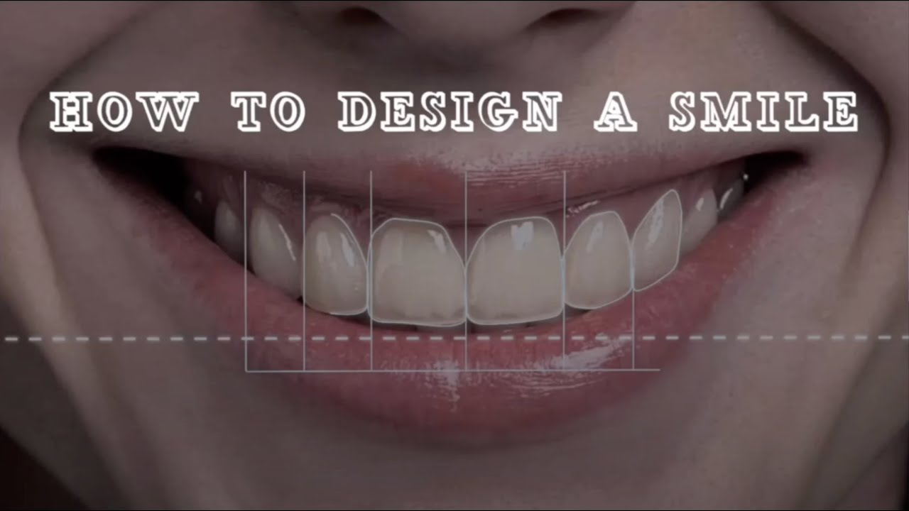 SMILE DESIGN PRINCIPALS- Ceramic Veneers