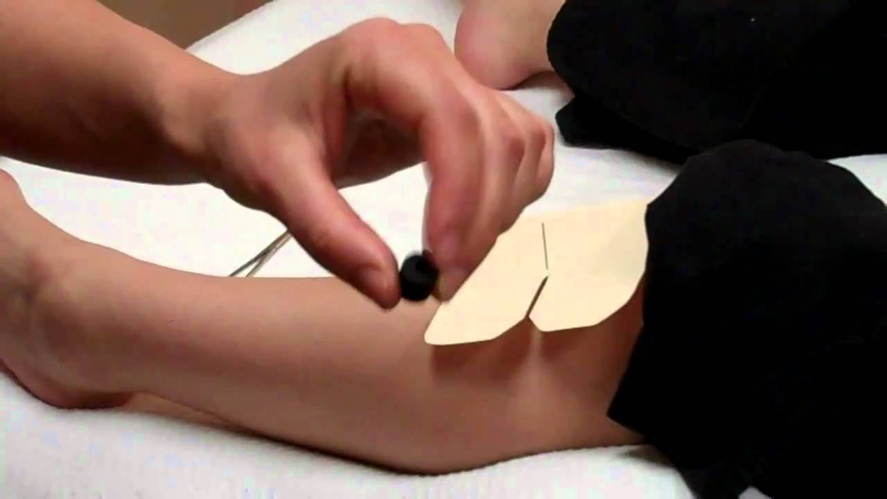 Energy Acupuncture Treatment Video