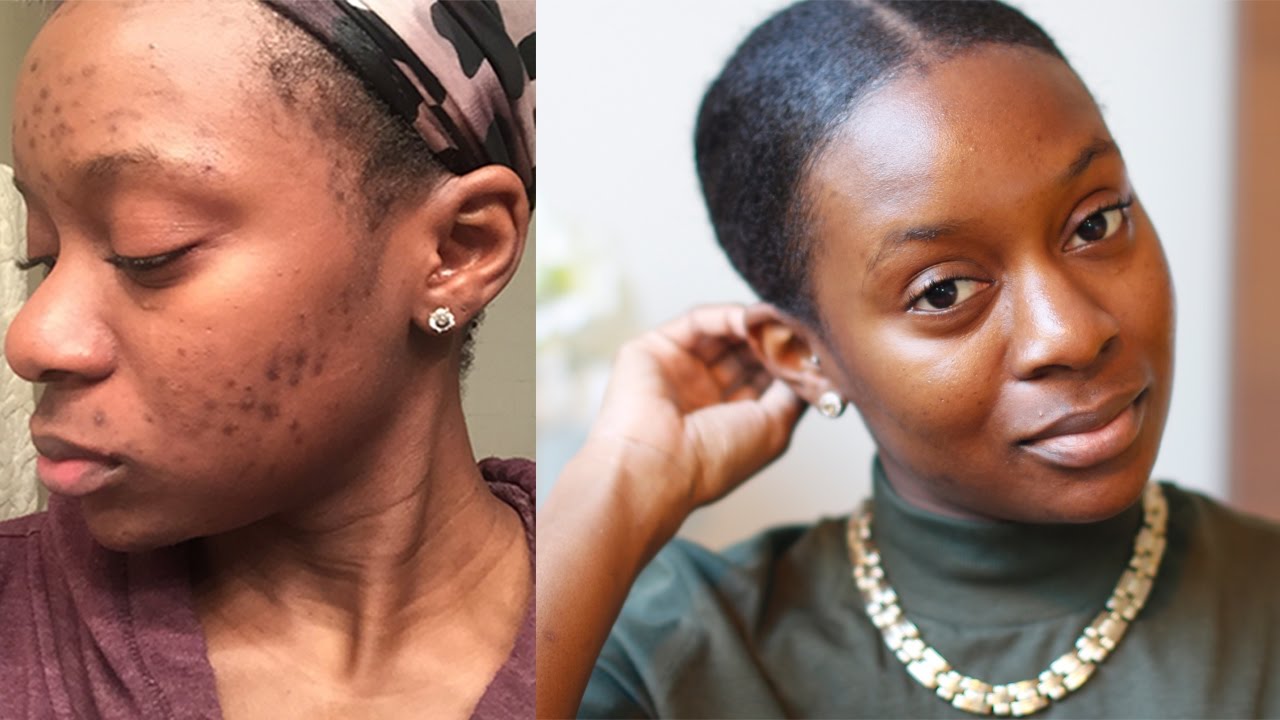 Clear Hyperpigmentation on Dark Skin | Chemical Peel & Skin Regimen